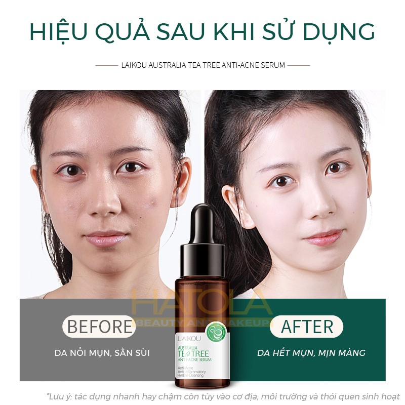 Serum Tràm Trà Dưỡng Da Tự Nhiên LAIKOU giảm thâm, thu nhỏ lỗ chân lông, Chăm sóc làn da hiệu quả