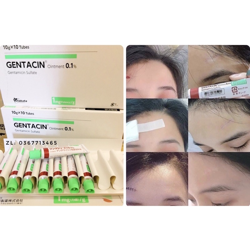 Kem giảm sẹo Gentacin Nhật Bản 10g