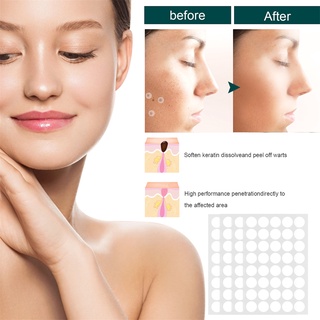 120 miếng dán trị mụn cóc trị mụn cóc nốt ruồi Bri