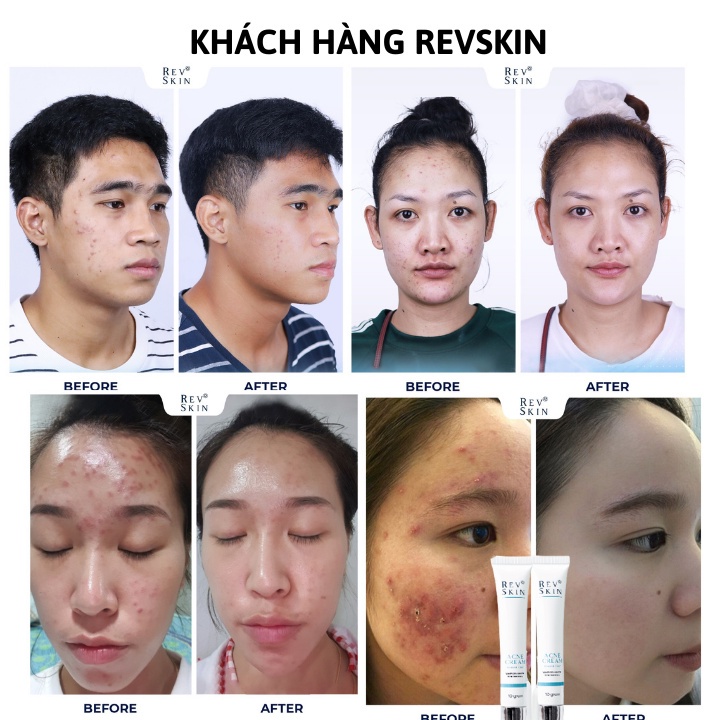 Kem Chấm Mụn RevSkin Acne Cream 10g giảm mụn sáng da, mờ thâm dược mỹ phẩm hàng chính hãng shop Hello Sun
