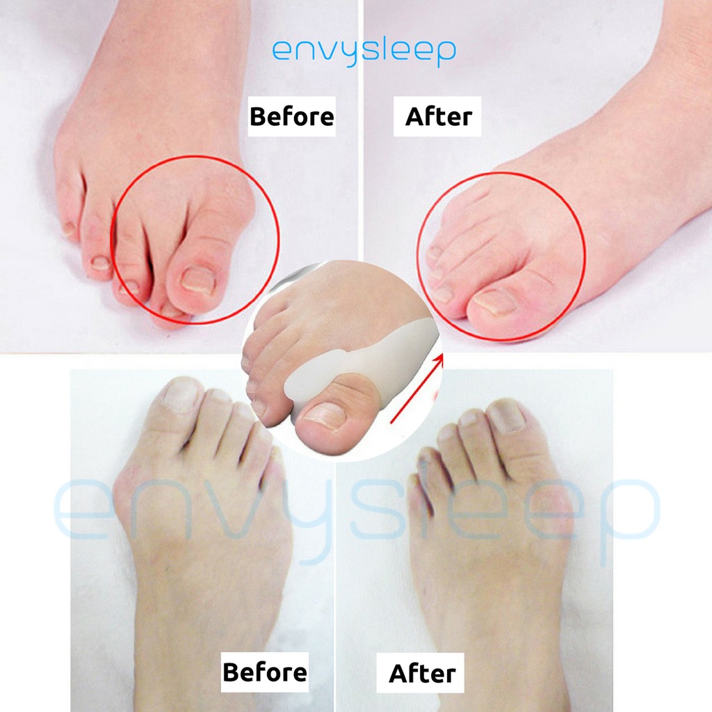 Follow_sale Lót silicon CHÍNH HÃNG Envysleep giảm đau ngón cái mang giày cao gót,  chống cong vẹo ngón chân, nam và nữ