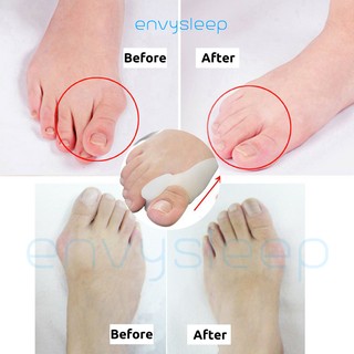 Follow_sale Lót silicon CHÍNH HÃNG Envysleep giảm đau ngón cái mang giày cao gót, chống cong vẹo ngón chân, nam và nữ thumbnail