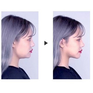 Miếng dán mặt VLine hộp 40 miếng