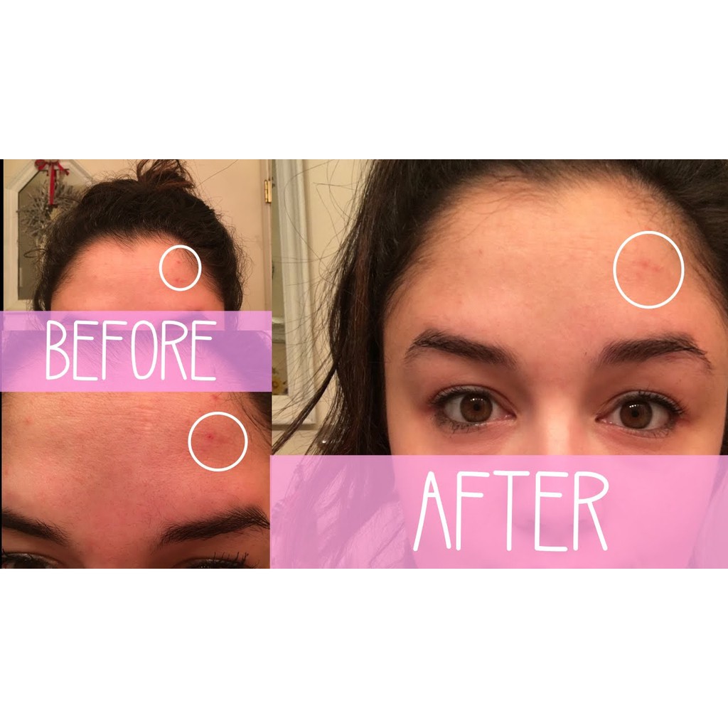 Chấm mụn Kate Sommerville Eradikate Acne Spot Treatment. | BigBuy360 - bigbuy360.vn