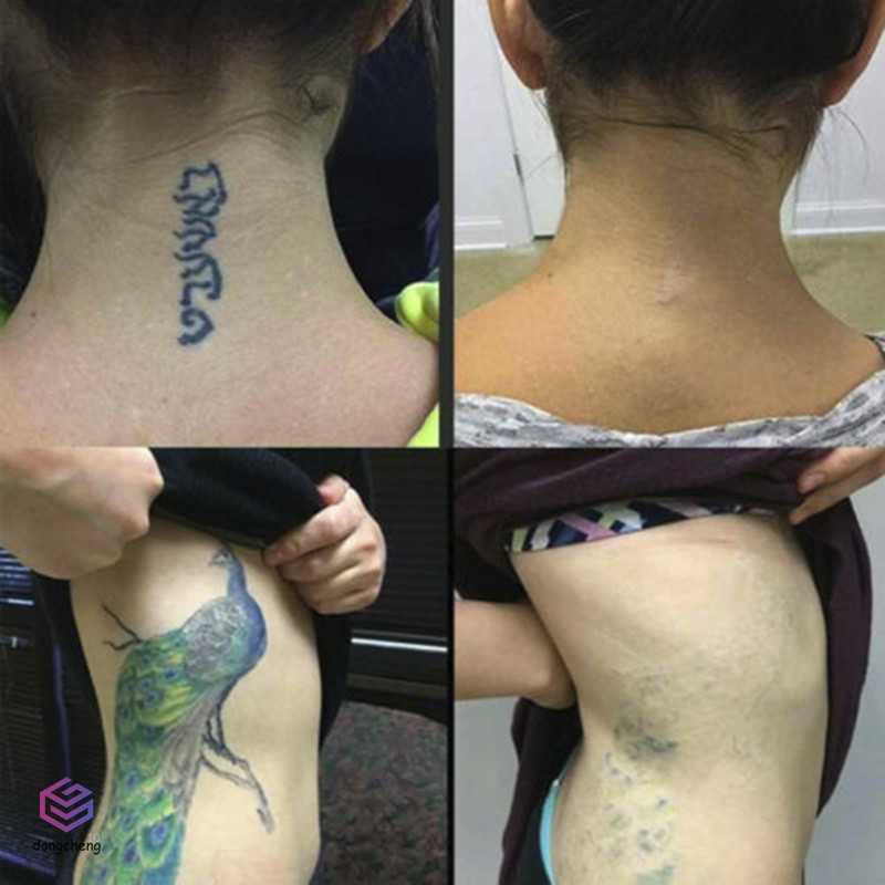 [Hàng mới về] Kem xóa hình xăm nhẹ nhàng không gây đau chuyên dụng