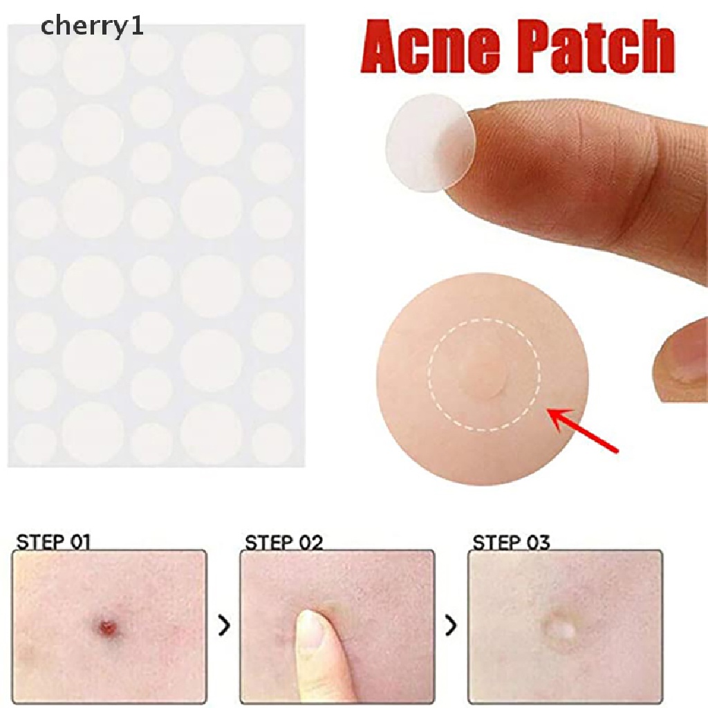 Bộ 36 Miếng Dán Hỗ trợ giảm mụn Hiệu Quả Tiện Dụng