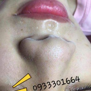Ủ mụn+ serum se khít