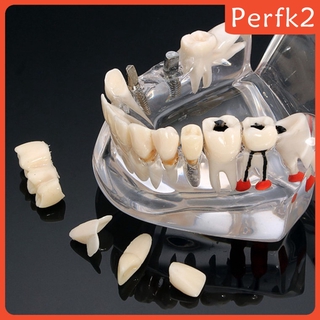 2x Human Mouth Dental Teeth Pathological Model Teaching Study Tools Clear