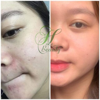 Kem Mụn X2 Th beauty