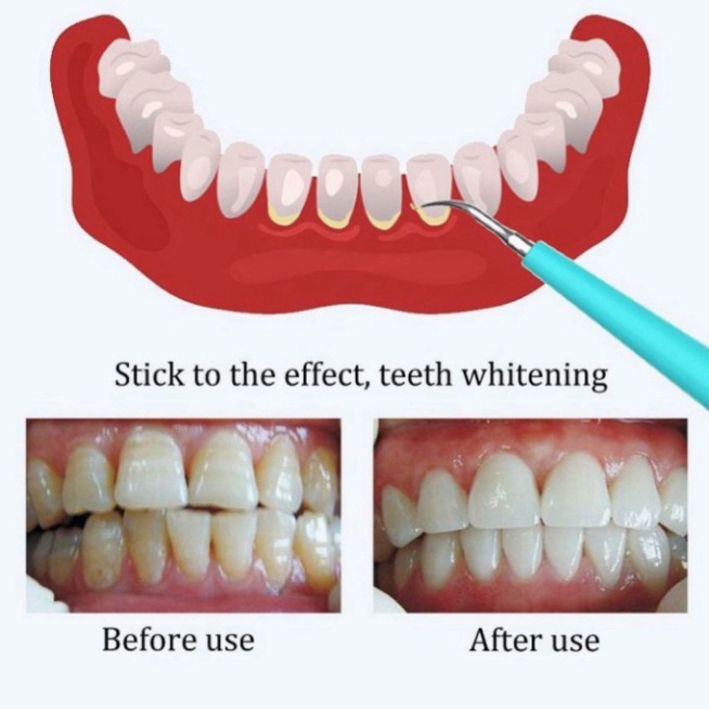 Dụng Cụ Lấy Cao Răng - Máy Lấy Cao Răng Tại Nhà Cao Cấp