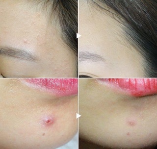 [Bill Hàn] Thanh CHẤM MỤN APIEU Nonco Tea Tree STICK