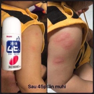 Lăn muỗi muhi cho bé