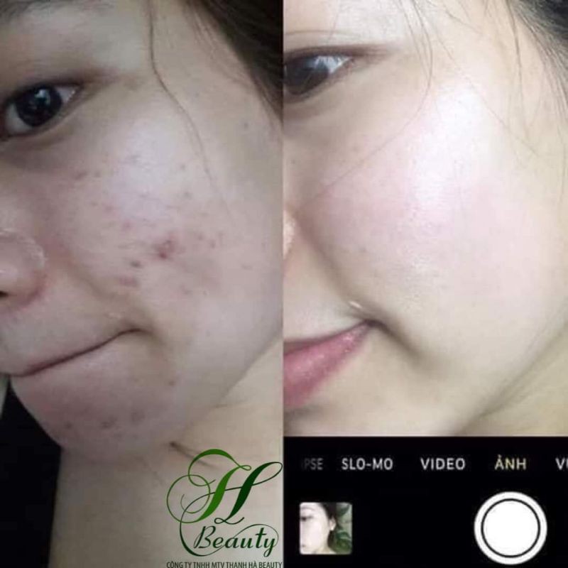 Kem Mụn X2 Th beauty