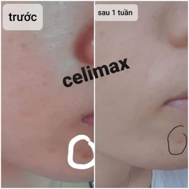 Serum tinh chất Phục hôi_cấp nước _ làm trắng Celimax The Real Noni