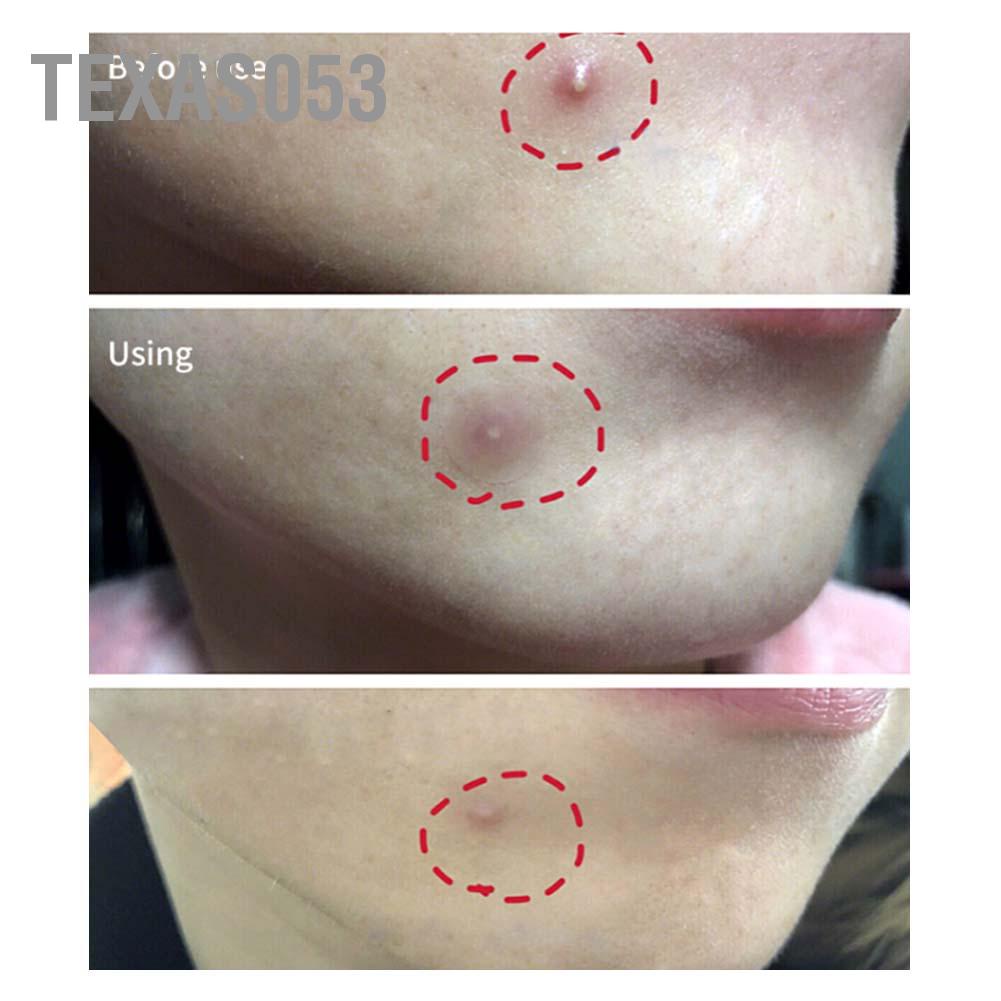 [Hàng mới về] 36 Miếng dán trong suốt sử dụng che khuyết điểm vùng mụn nhọt Texas053