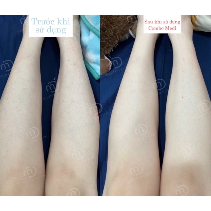 Body Mask Mediskincare | BigBuy360 - bigbuy360.vn