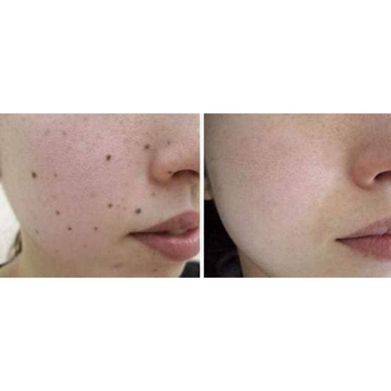 combo 100 mụn cóc mụn ruồi của nga
