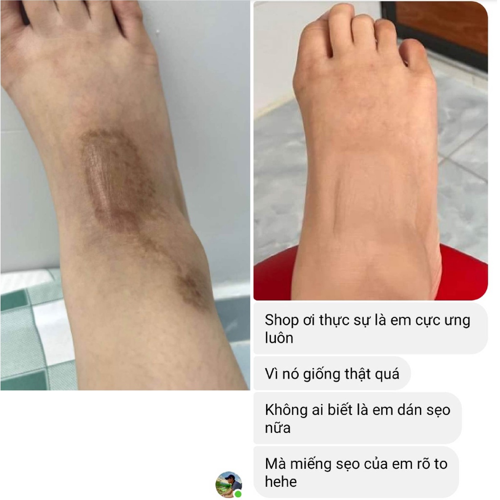 Miếng dán che khuyết điểm che sẹo lồi sẹo lõm sẹo thâm tiệp màu da TATUCA 4 kích thước A1001