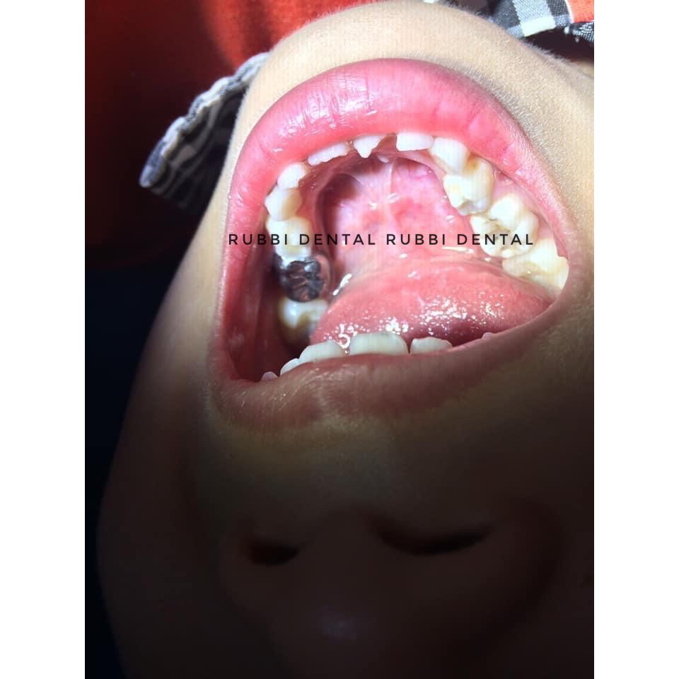 Chụp thép bảo vệ răng sữa khắc phục tình trạng sâu răng dùng trong nha khoa