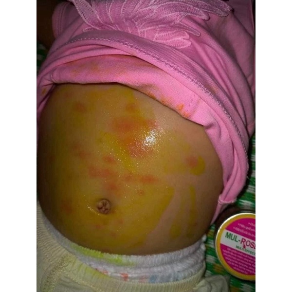 [Chính hãng] Kem nghệ đa năng Mulrose ngừa mụn đẹp da mờ sẹo