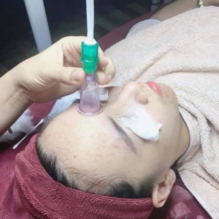 Bộ giác hơi hút máu độc thải độc đả thông kinh mạch
