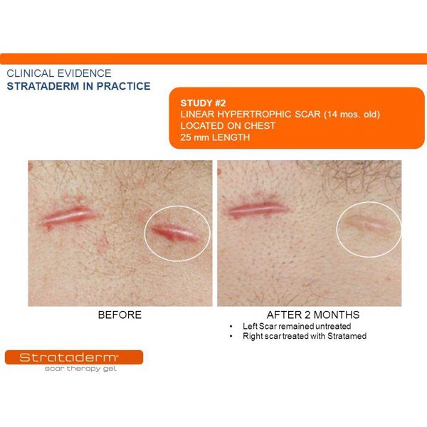 Strataderm – Gel hỗ trợ xóa mờ sẹo chính hãng Thụy Sĩ - 5g 10g 20g .