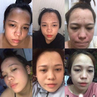 COMBO SERUM THẢO DƯỢC NGỌC LINH SÂM +SỮA RỮA MẶT ĐÁNH BAY MỤN NÁM TÀN NHANG...