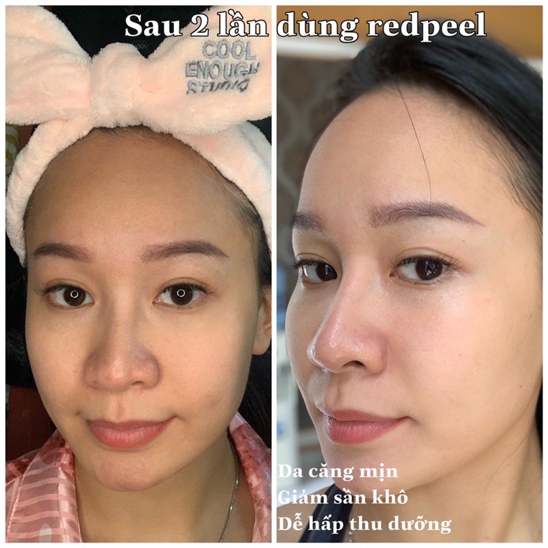 Tẩy tế bào chết Hoá Học RedPeel Tingle Serum Tái Tạo Làn Da Đẹp Chuẩn Hàn Quốc chính hãng | BigBuy360 - bigbuy360.vn