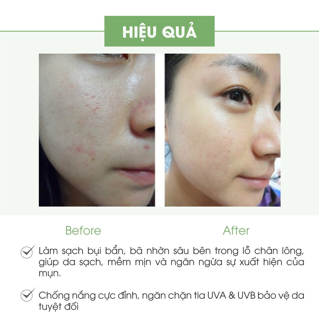 Bộ sản phẩm làm trắng và ngăn ngừa mụn Truesky gồm 1 kem dưỡng trắng da mặt 20g + 1 gel rửa mặt ngừa mụn 50g | BigBuy360 - bigbuy360.vn