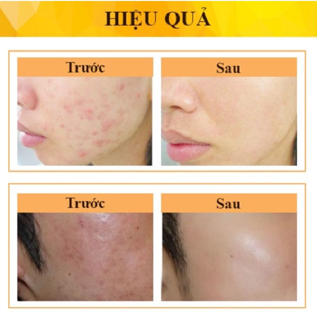 Kem Giảm Mụn Derma Forte