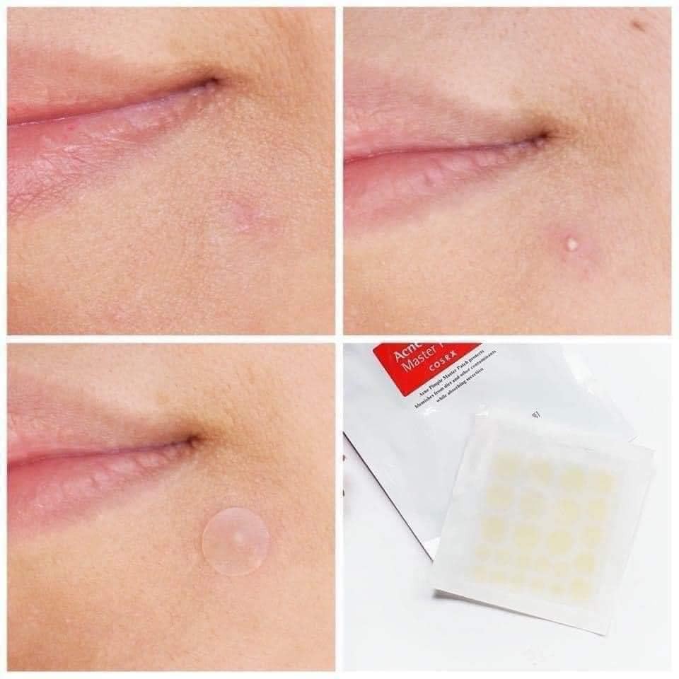 Miếng Dán Mụn Cosrx Đỏ Acne Pimple Master Patch