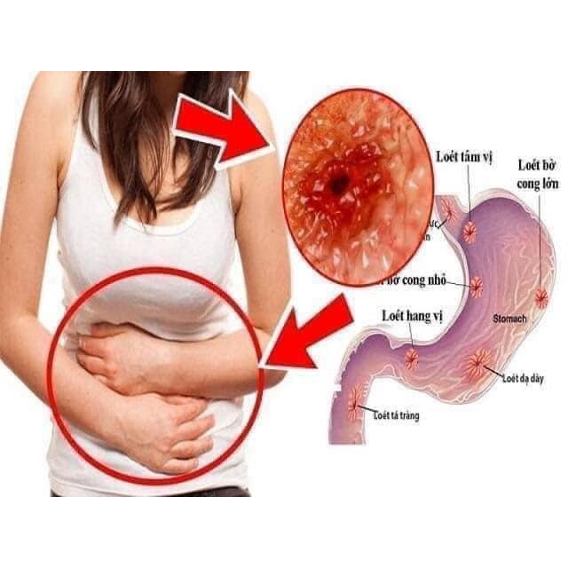 Nexium 24hr Mỹ, Viên Uống Đau Dạ Dày Ợ Nóng