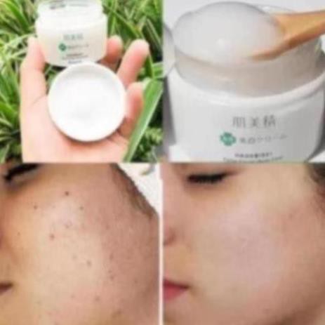 hauphuchhhhh Kem Dưỡng Ngăn Ngừa Mụn và Dưỡng Trắng Kracie Hadabisei Acne -Mỹ Phẩm Nhật Nôi Đia AyakaShop. Ma20s