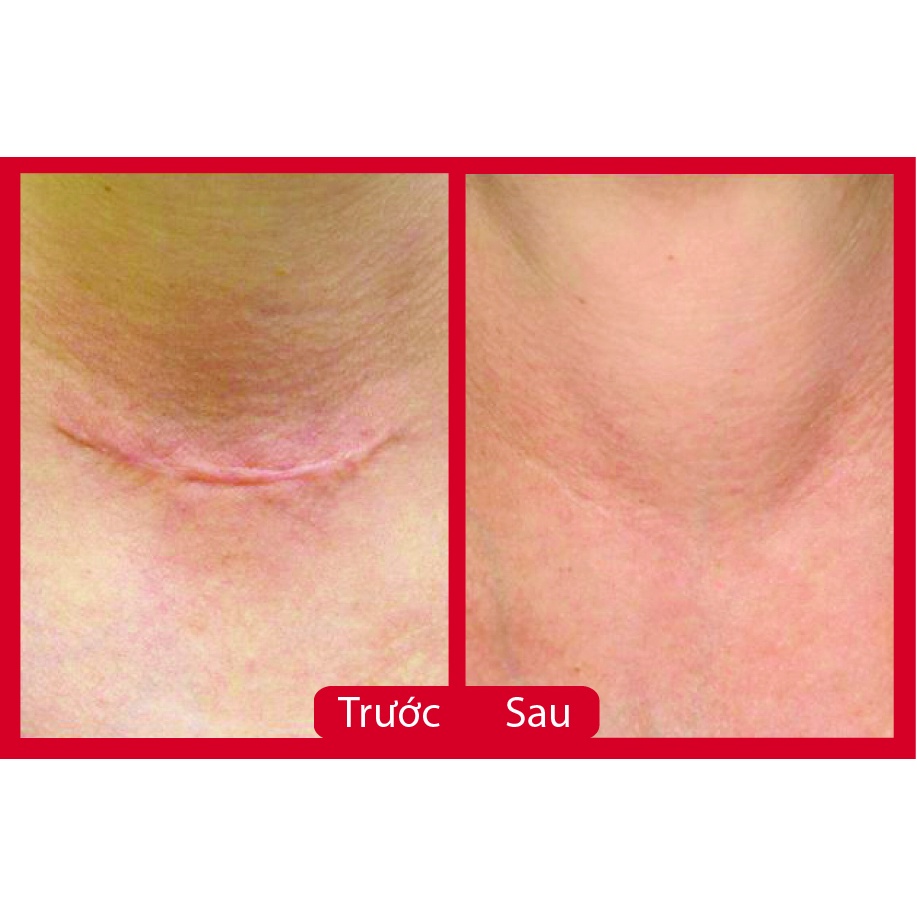 Serum ngừa sẹo scar kem giảm các vết sẹo lồi lõm rỗ lâu năm 15ml