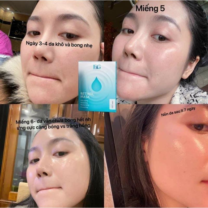 Mặt nạ Retinol_điều trị mụn hiệu quả