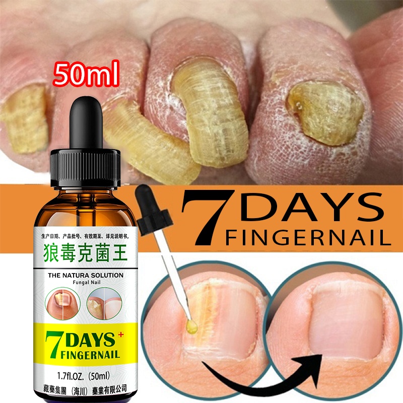 Tinh Chất Hỗ Trợ Giảm Bệnh Nấm Móng Chăm Sóc Móng Tay Tiện Dụng