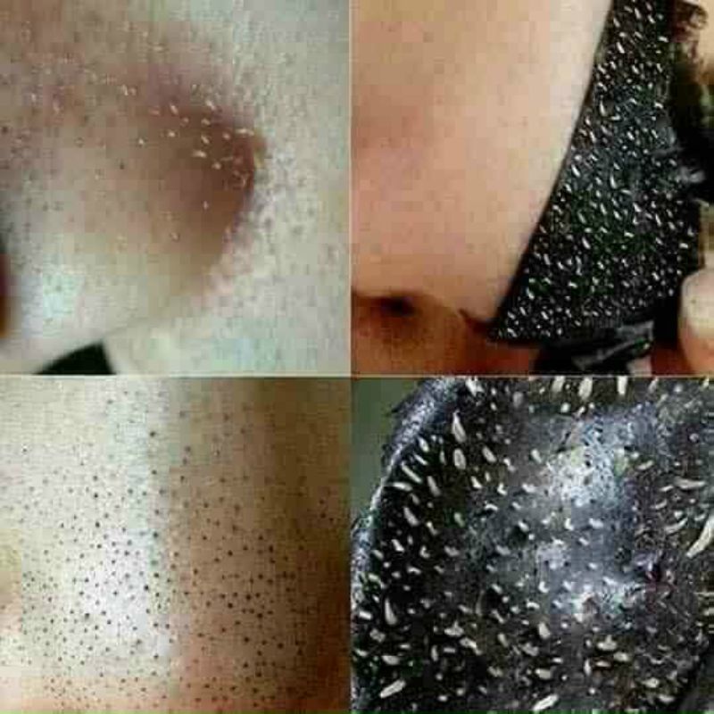 Lột mụn kone