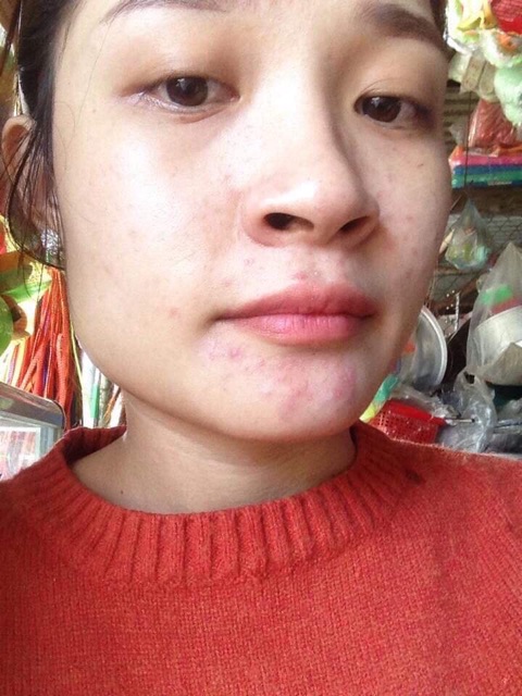 Kem nghệ Qcare tr mụn thâm trắng da Thái lan chính hãng | BigBuy360 - bigbuy360.vn