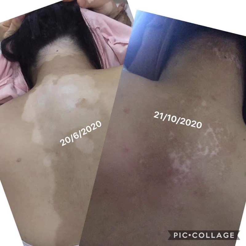 thảo dược bôi bạch biến | BigBuy360 - bigbuy360.vn