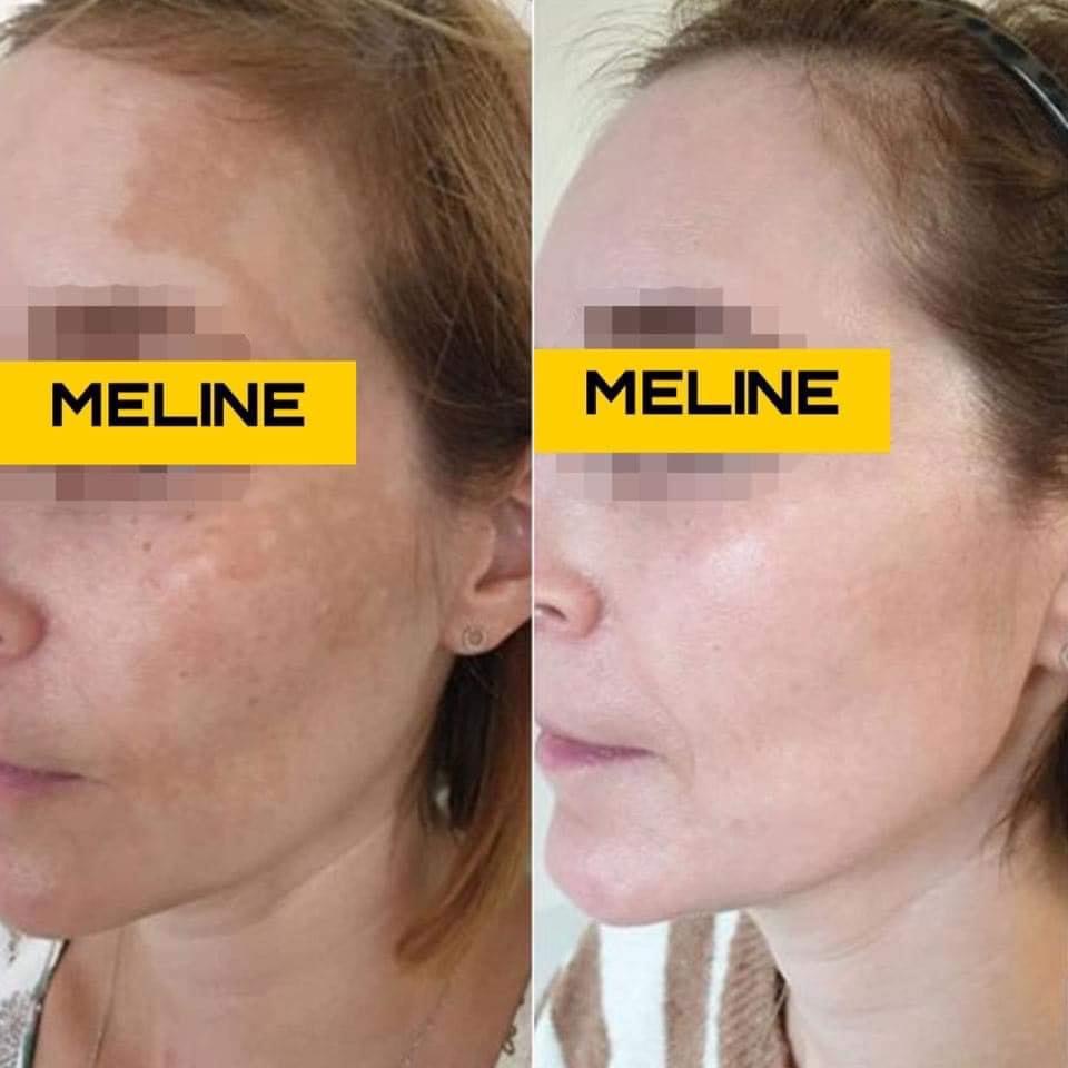 Meline 02 Inno Caucasian Skin Day Huyết Thanh Giảm Thâm Sạm Nám  Phân Giải Sắc Tố Dưỡng Trắng Sáng Da