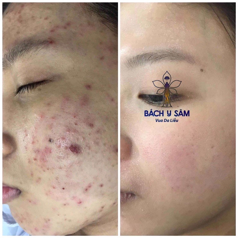 (Rẻ vô địch )bạch linh- bách y sâm chuyên mụn(mẫu mới 30ml)