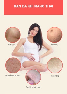 Kem trị rạn và làm mờ vết rạn Bella B