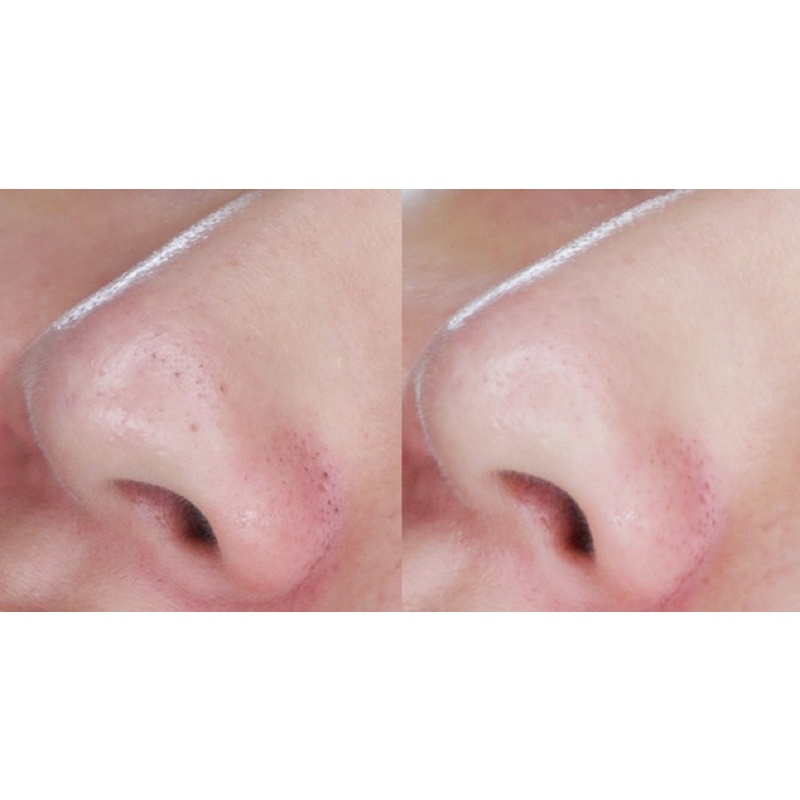 Miếng dán lột mụn đầu đen HATHERINE Pore Clear Black/ White/ Teatree Nose Strip