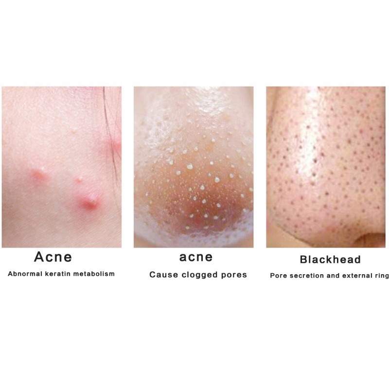 Set 5 Dụng Cụ Nặn Mụn Bằng Thép Không Gỉ Kèm Hộp Đựng Tiện Lợi