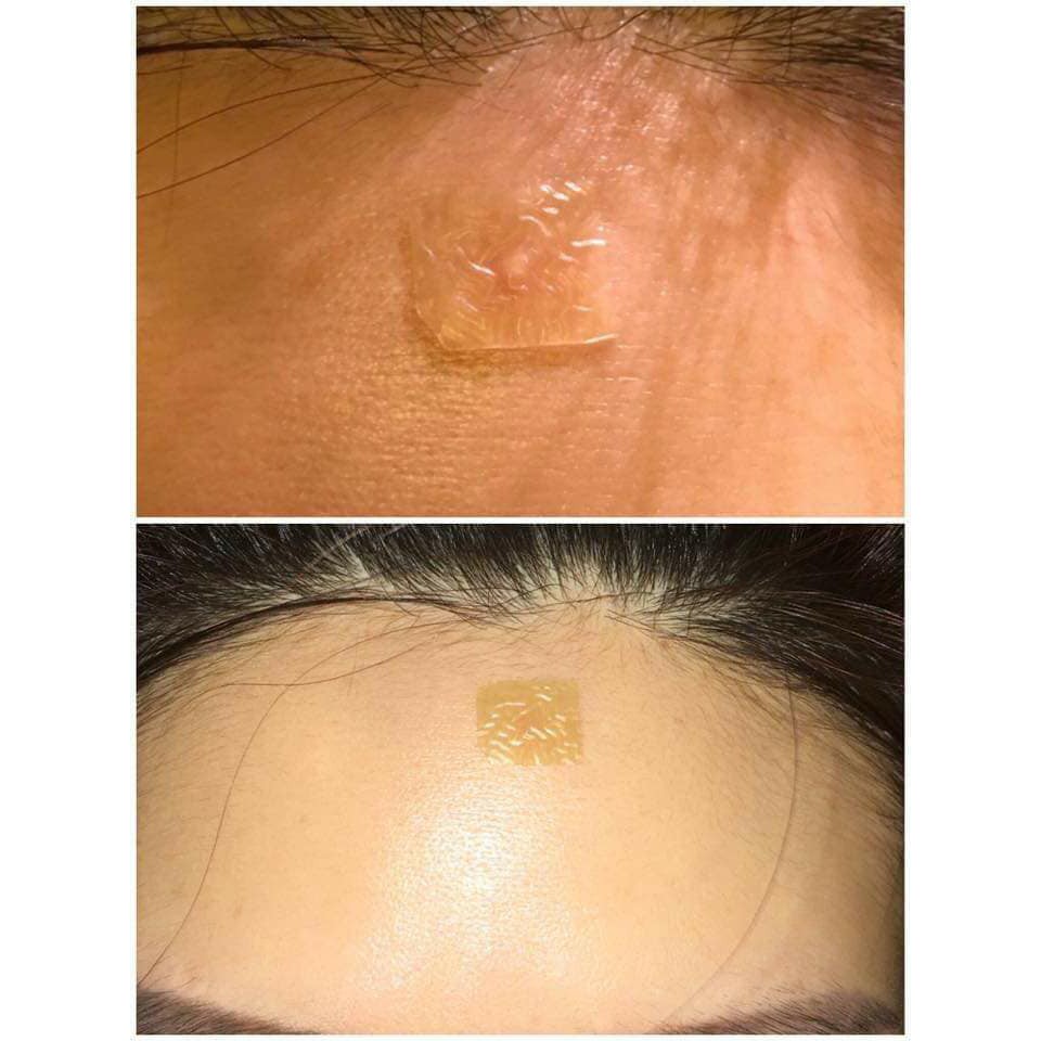 Miếng Dán Hút Mụn, mủ Duoderm Extra Thin