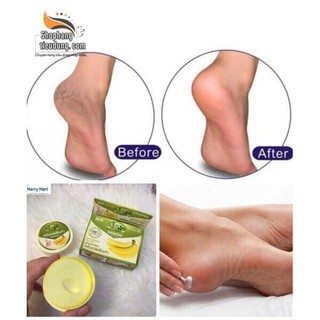 Kem xóa nứt gót chân chuối Thái Lan
