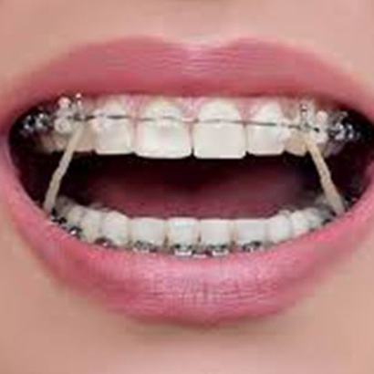 Thun kéo niềng răng-thun chỉnh nha liên hàm