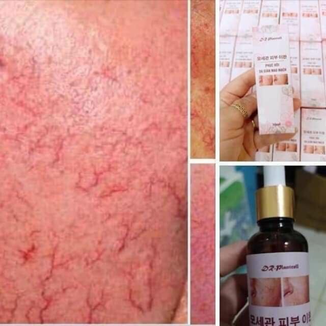 Phục hồi da giản mao mạch