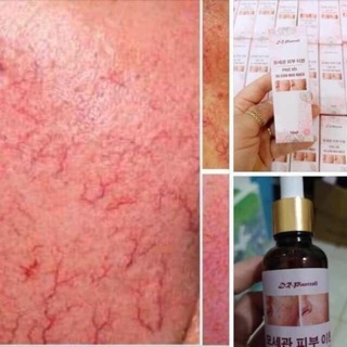 Phục hồi da giản mao mạch