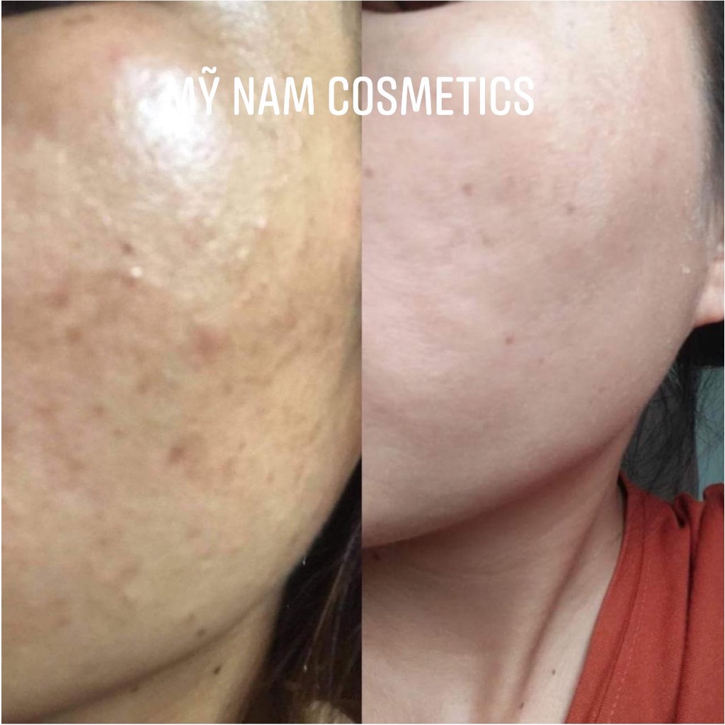 Combo dưỡng da mỹ nam -cải thiên tận gốc mụn, thâm nám, tàn nhang